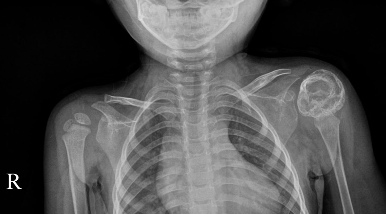 Figure 4 for case Myositis ossificans
